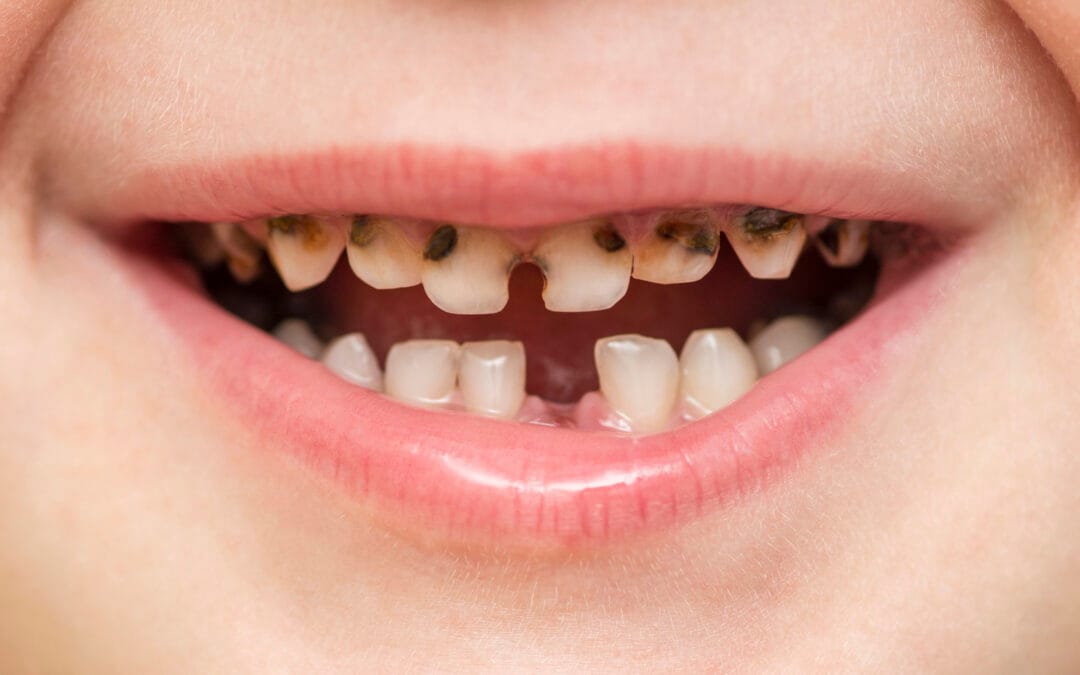 Tooth Truth: what’s really behind our children's cavities?