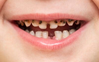 Tooth Truth: what’s really behind our children's cavities?