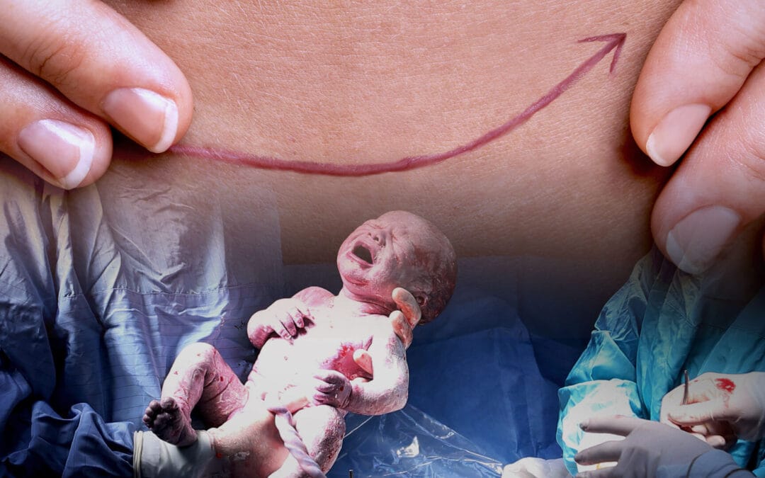 Birth on the clock: the hidden costs of the caesarean surge